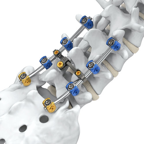 Sistema de osteosíntesis lumbosacro - Arsenal™  - Alphatec Spine - vía posterior / para adulto