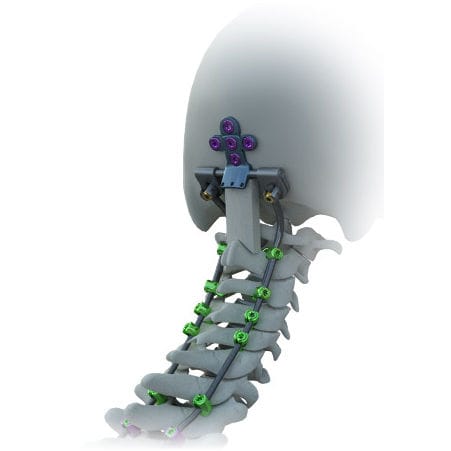 Sistema de osteosíntesis occipitocervical - Avalon® - Alphatec Spine - vía posterior / para adulto
