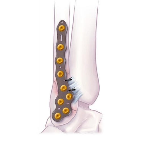 Placa de compresión para peroné - VOLITION™  - Ortho Solutions - para maléolo / porción distal / lateral