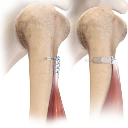 Anclaje de sutura tendón bicipital - FiberTak® 2-0 FiberLink™  - Arthrex - no reabsorbible