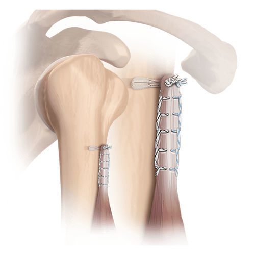 Anclaje de sutura tendón bicipital - FiberTak® - Arthrex - no reabsorbible