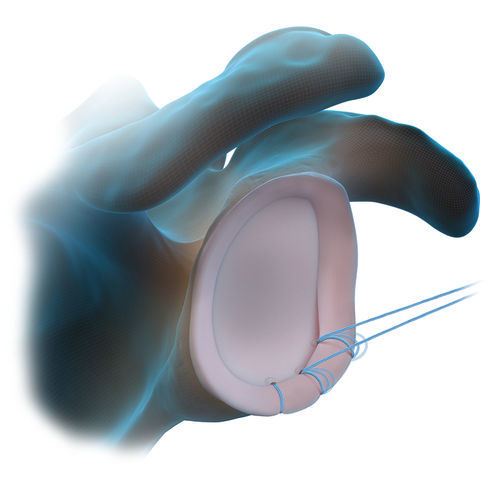 Anclaje de sutura labrum glenoideo - FiberTak® - Arthrex - no reabsorbible / sin nudos