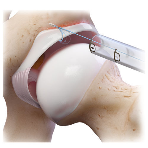 Anclaje de sutura labro acetabular - FiberTak® - Arthrex - no reabsorbible / sin nudos