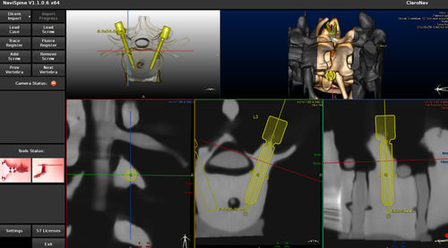 Software para cirugía asistida por robot - NAVIX - Claron Technology - de navegación quirúrgica / de columna vertebral