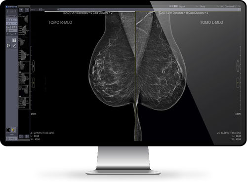 PACS para imágenes médicas - Mammo - INFINITT North America