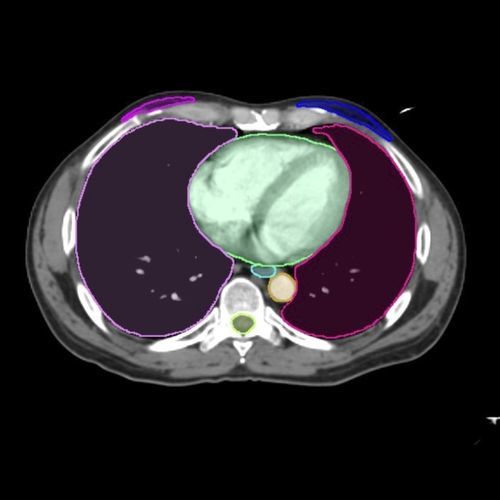 Plataforma de IA para imágenes médicas - Contour ProtégéAI® - MIM Software - de contorneo / de estandarización