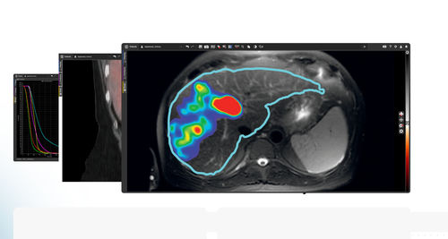 Software TDM - MIM SurePlan™ LiverY90 - MIM Software - TEP / SPECT / de oncología