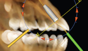 Módulo de software de implantología dental - Anatomage - de visualización 3D / de planificación / de simulación de implante dental