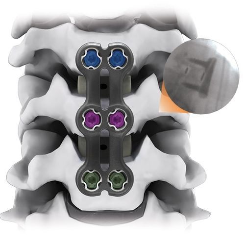 Placa de artrodesis para vértebra cervical - IRIS® - Life Spine - bloqueada / 2 niveles