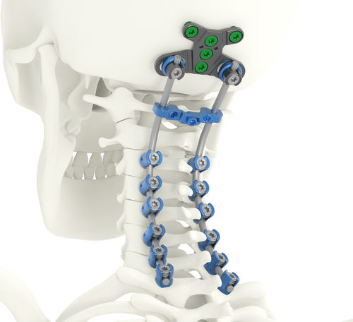 Sistema de osteosíntesis occipitocervicotorácico - SOLSTICE® - Life Spine - vía posterior / para adulto
