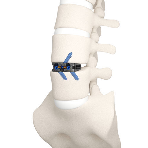 Caja intersomática lumbar - DYNA-LINK® - Life Spine - vía anterior / de titanio