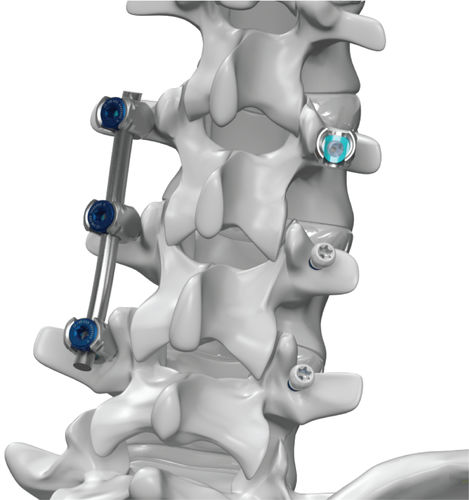 Sistema de osteosíntesis toracolumbar - ARx® - Life Spine - vía posterior / para adulto