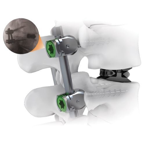 Sistema de osteosíntesis toracolumbar - CENTERLINE® - Life Spine - vía posterior / para adulto