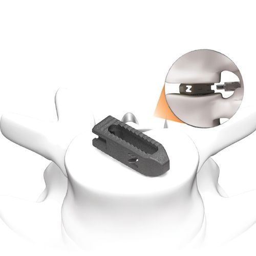 Caja intersomática toracolumbar - PLATEAU®-Z - Life Spine - vía posterior / vía transforaminal / de titanio