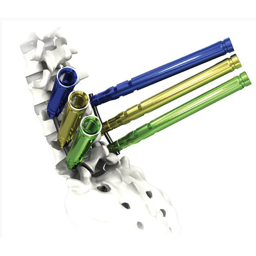 Sistema de osteosíntesis toracolumbar - AVATAR® - Life Spine - vía posterior / para adulto