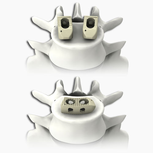 Caja intersomática lumbar - PLATEAU® - Life Spine - vía posterior / vía transforaminal / de PEEK