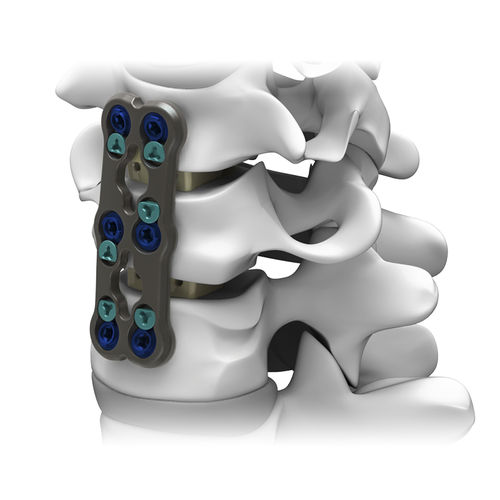 Placa de artrodesis cervical - GRUVE™ - Life Spine - bloqueada / metálica / 2 niveles