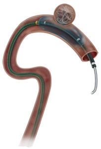 Catéter de oclusión - Scepter C® - MicroVention - vaso sanguíneo / con balón / con revestimiento hidrófilo