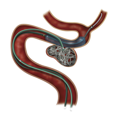 Vaina de acceso transeptal - Headway® Duo - MicroVention