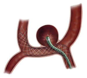 Stent periférico - LVIS™ Jr. - MicroVention - de nitinol / autoexpandible