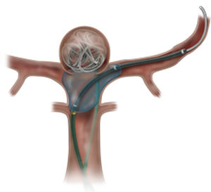 Catéter vaso sanguíneo - Scepter XC® - MicroVention - con balón / con revestimiento hidrófilo