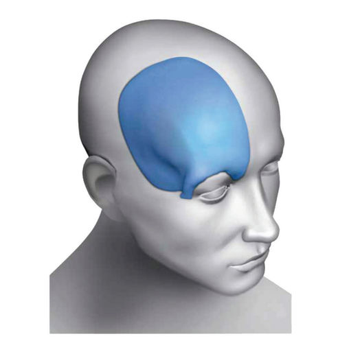 Implante craneal a medida - Matrix Omnipore®  - Acumed