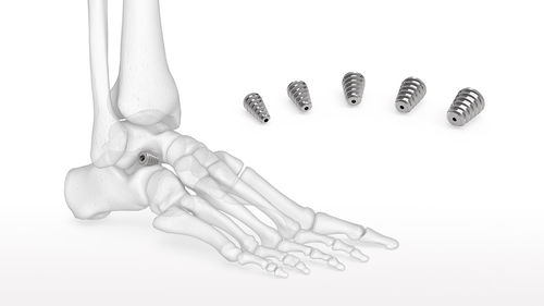 Implante de articulación subtalar - Talar-Fit™ - Acumed
