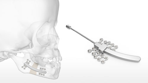 Distractor mandibular - Logic™ Jr - Acumed - interno / pediátrico