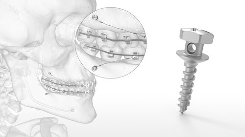 Miniimplante de titanio - OMI™ - Acumed - de tornillo / de anclaje ortodóntico / cortical