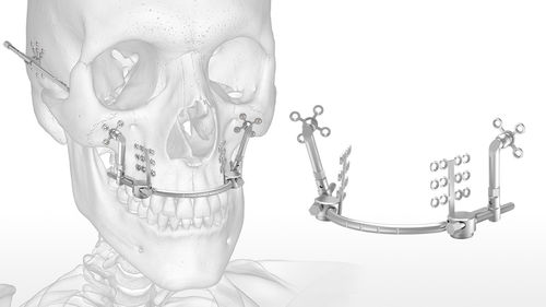 Distractor maxilar - Spectrum™ - Acumed - interno / para adulto