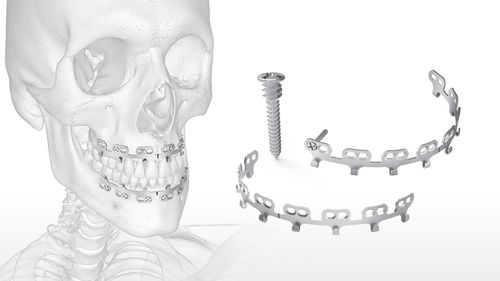 Distractor mandibular - QuickFix™ MMF - Acumed - externo / para adulto