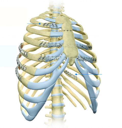 Placa de compresión para costillas - BioBridge - Acumed - porción proximal / porción medial / metálica