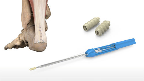 Anclaje de sutura tendón calcáneo - 46-0008-S - Acumed - para ligamento talocalcáneo / no reabsorbible