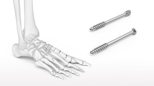 Tornillo de compresión ósea para retropié - ExtremiFix™ - Acumed - para tobillo / canulado / sin cabeza