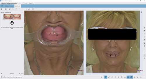 Módulo de software para odontología - 3D Denture Guide - AGE Solutions - de captura
