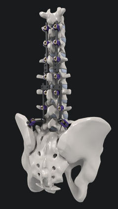 Sistema de osteosíntesis toracolumbar - SYNSTER® DOMINO - BM Korea - vía posterior / para adulto