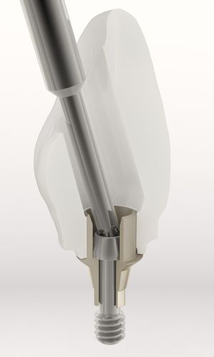 Pilar para implante de titanio - BH - DESS AURUM Base™ - Dess Dental Smart Solutions - hexágono externo / recto