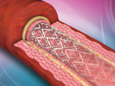 Stent arteria coronaria - ReNATURAL - Cardionovum - de metal / biorreabsorbible