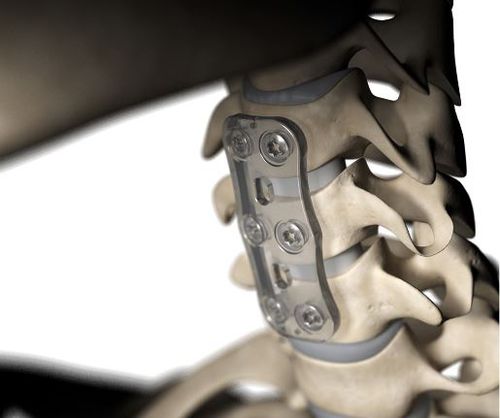 Placa de artrodesis para vértebra cervical - S-1™ - Inion - polímero biorreabsorbible / 2 niveles / 1 nivel