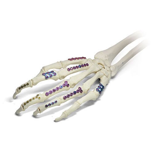 Placa de compresión para falange de la mano - SIGNEX - OSTEONIC - bloqueada / metálica