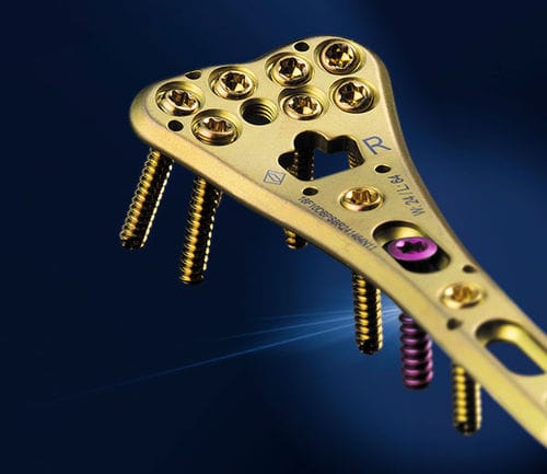 Placa de compresión para radio - SIGNEX - OSTEONIC - porción distal / bloqueada / metálica