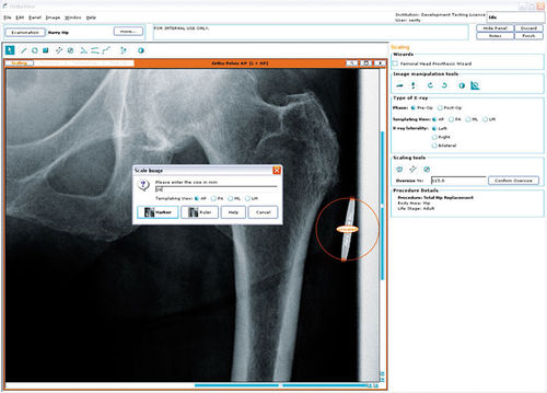 Software para cirugía de la cadera - Hip Arthroplasty - OrthoView - para cirugía ortopédica / médico / de planificación preoperatoria