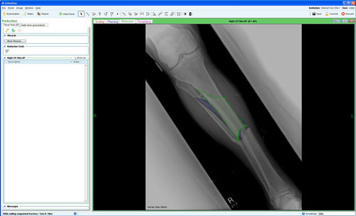 Módulo de software de gestión - Fracture Management - OrthoView - de planificación / para cirugía ortopédica