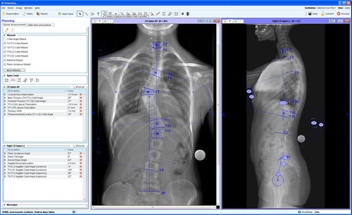 Módulo de software de gestión - Spinal Deformity Assessment - OrthoView - de planificación preoperatoria / para cirugía ortopédica / de columna vertebral