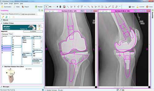 Software de planificación preoperatoria - Knee Arthroplasty - OrthoView - para cirugía de la rodilla