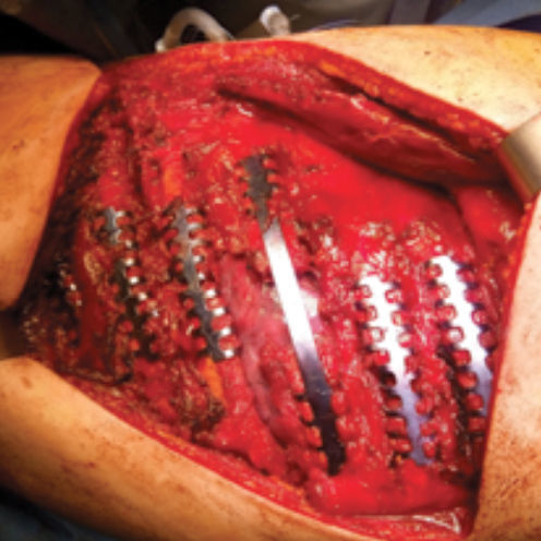 Prótesis costal para la reconstrucción tras resección de osteosarcoma - 37.706 series - Medicalex