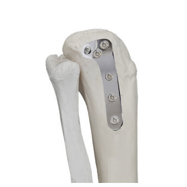 Placa de compresión para tibia - 37.803 series - Medicalex - porción proximal / lateral / no bloqueada