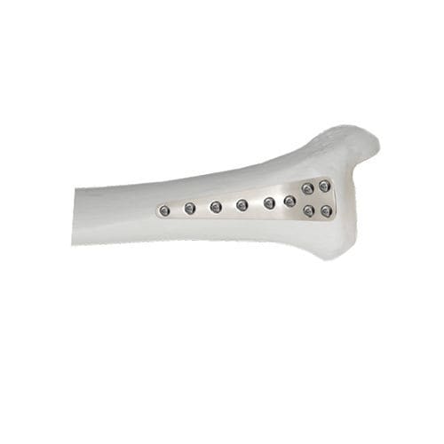 Placa de compresión para tibia - 37.804 series - Medicalex - porción distal / anterolateral / bloqueada