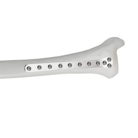 Placa de compresión para tibia - 37.804.0 series - Medicalex - porción distal / bloqueada / metálica