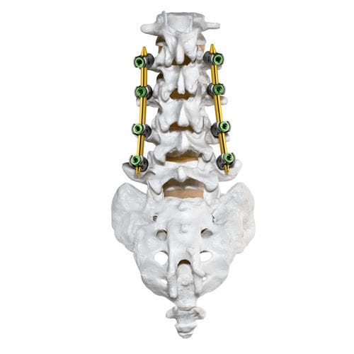 Sistema de posicionamiento de tornillos pediculares mínimamente invasivo - CREO MIS®  - Globus Medical